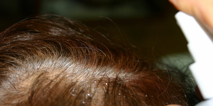 育毛剤を頭皮にスプレーする女性の画像