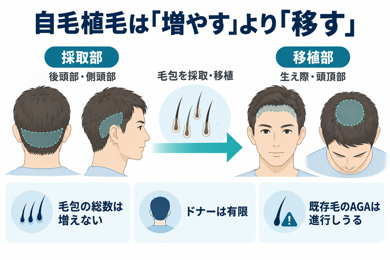 自毛植毛で後頭部・側頭部の毛包を生え際・頭頂部へ移す仕組み