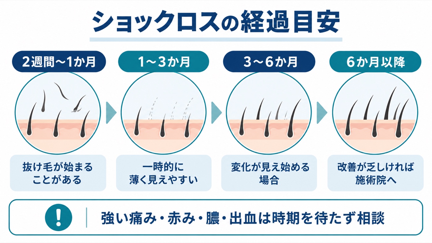 自毛植毛後2週間から6か月以降までのショックロス経過と相談目安